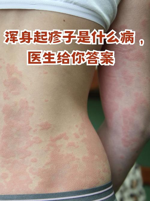 现在感染症状有哪些 现在感染症状有哪些表现