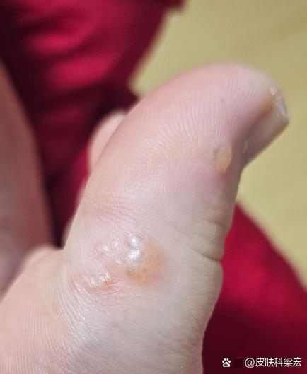 脚上起小水泡还很痒是什么原因 脚上起小水泡很痒的原因